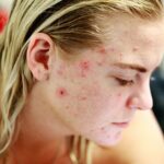 Karbonový peeling pro mastnou a aknózní pleť: funguje, nebo je to jen přechodný výstřelek?